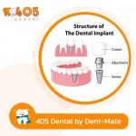 ทำรากฟันเทียมโปรโมชั่นพิเศษ - คลินิกทันตกรรม 405 เด็นทัล