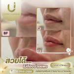 ฉีดฟิลเลอร์ปาก บางแสน ศรีราชา ชลบุรี - คลินิกเสริมความงาม บางแสน - ยูแอนด์ไอ คลินิก