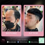 วิกผมปิดหัวล้าน - ร้านวิกผมติดกาว ช่างองุ่น - Dara Hairwig