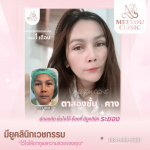 คลินิกรักษาสิวระยอง - คลินิกความงามระยอง - มียูคลินิก เวชกรรม