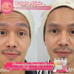 บริการโบท็อก อุดมสุข - บริษัท บุปผาคลินิก จำกัด