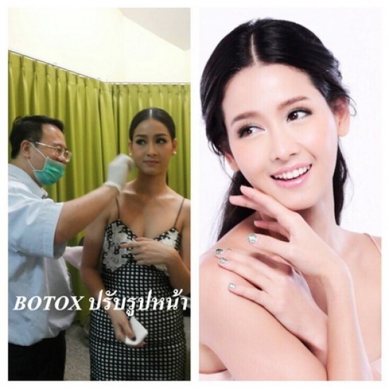 ฉีด Botox ปรับหน้าเรียว Botox ปรับหน้าเรียว 