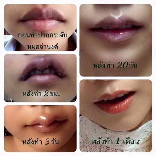 ศัลกรรมทำปากกระจับ ศัลกรรมทำปากกระจับเกาหลี 