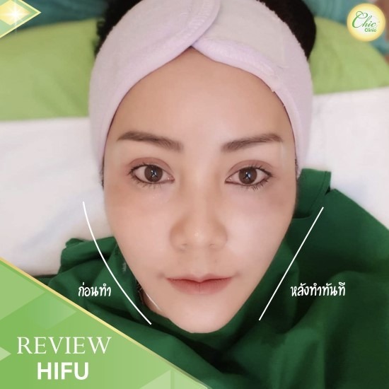 HIFU เชียงราย HIFU เชียงราย 