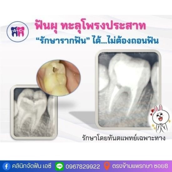 คลินิกรักษารากฟัน สมุทรปราการ