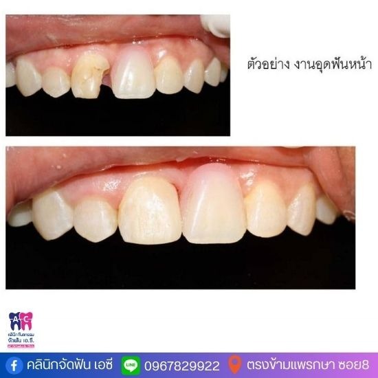 คลินิกทำฟัน อุดฟัน ขูดหินปูน สมุทรปราการ