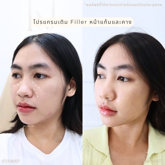 ฟิลเลอร์ รัชดา ฟิลเลอร์ รัชดา