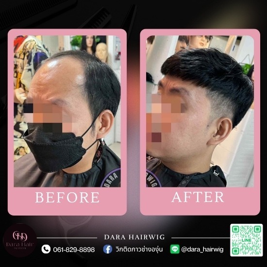 วิกผมปิดหัวล้าน วิกผมปิดหัวล้าน  วิกผมผู้ชาย หัวล้าน  วิกหัวล้าน ซื้อที่ไหน  วิกผมผู้ชาย ใกล้ฉัน  วิกผมผู้ชาย ซื้อ ที่ไหน  วิกผมติดกาวผู้ชาย 